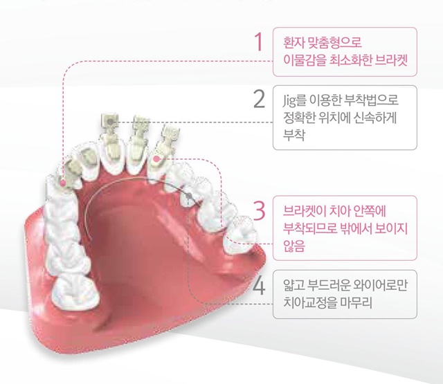 디지털교정이란
